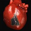 Miokarda infarkts