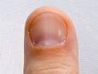 Inflammation of the nail bed